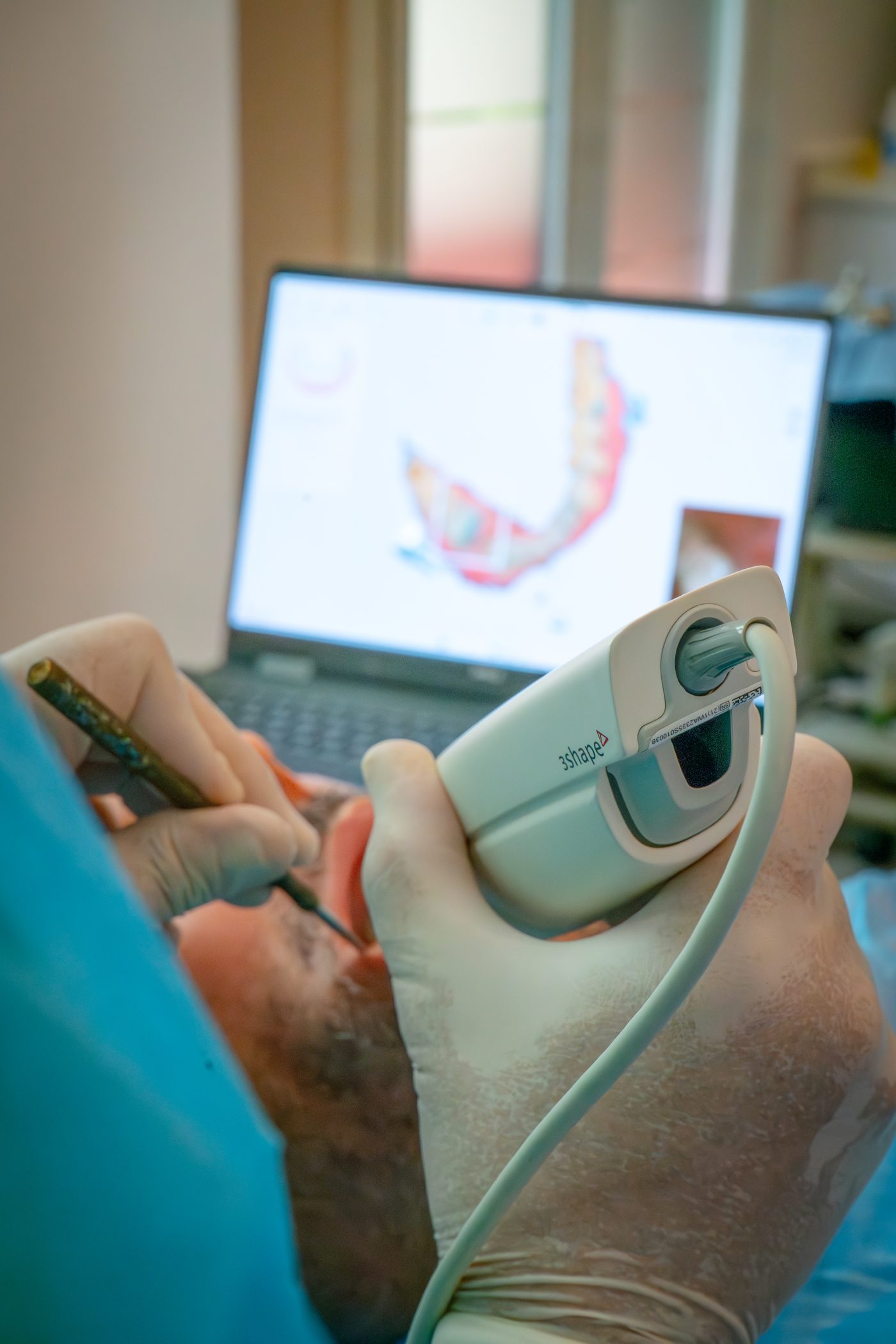 Diagnóstico 3D de implante dental fallido en Clínica DVM Madrid