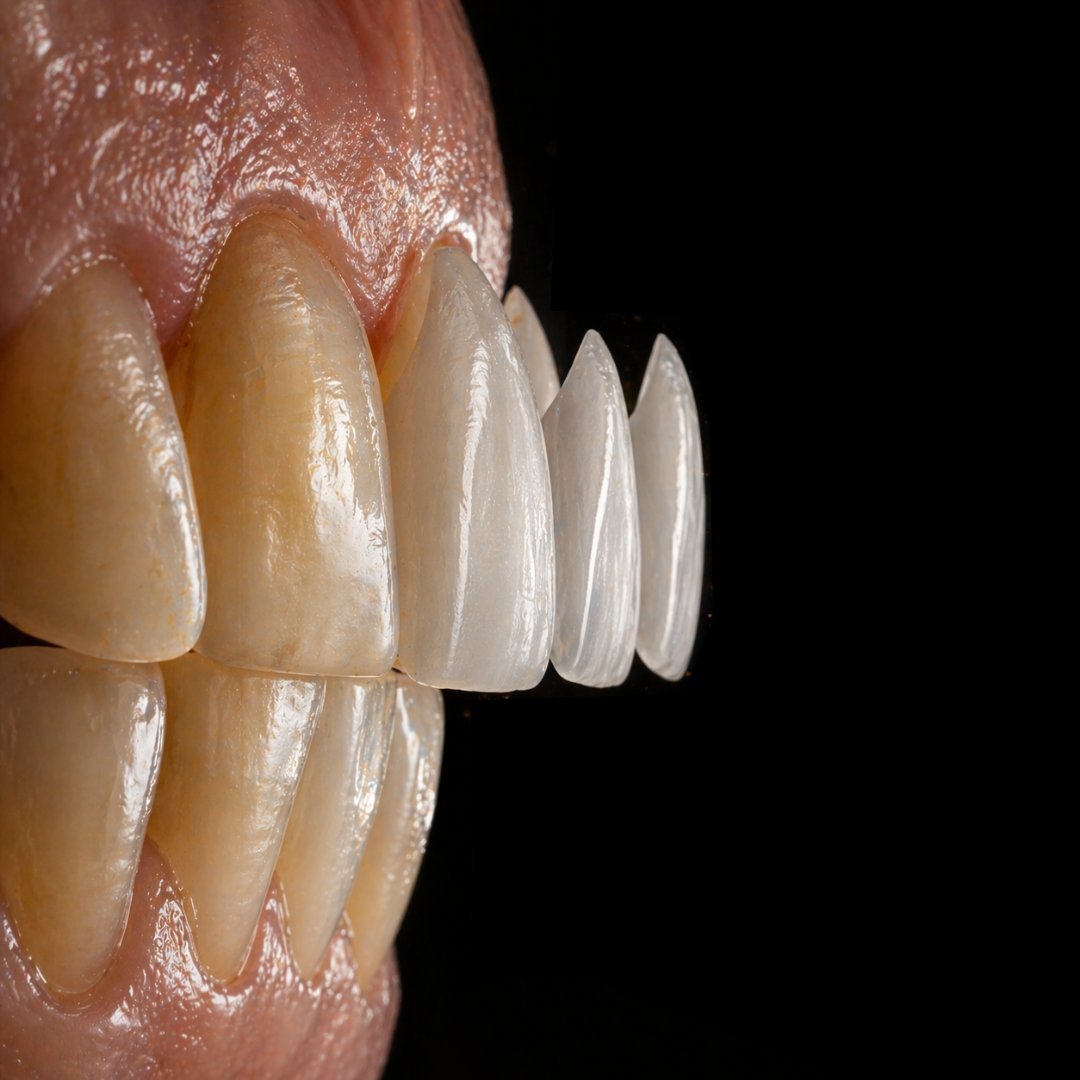 Carillas dentales de porcelana y estética dental en Clínica DVM Madrid