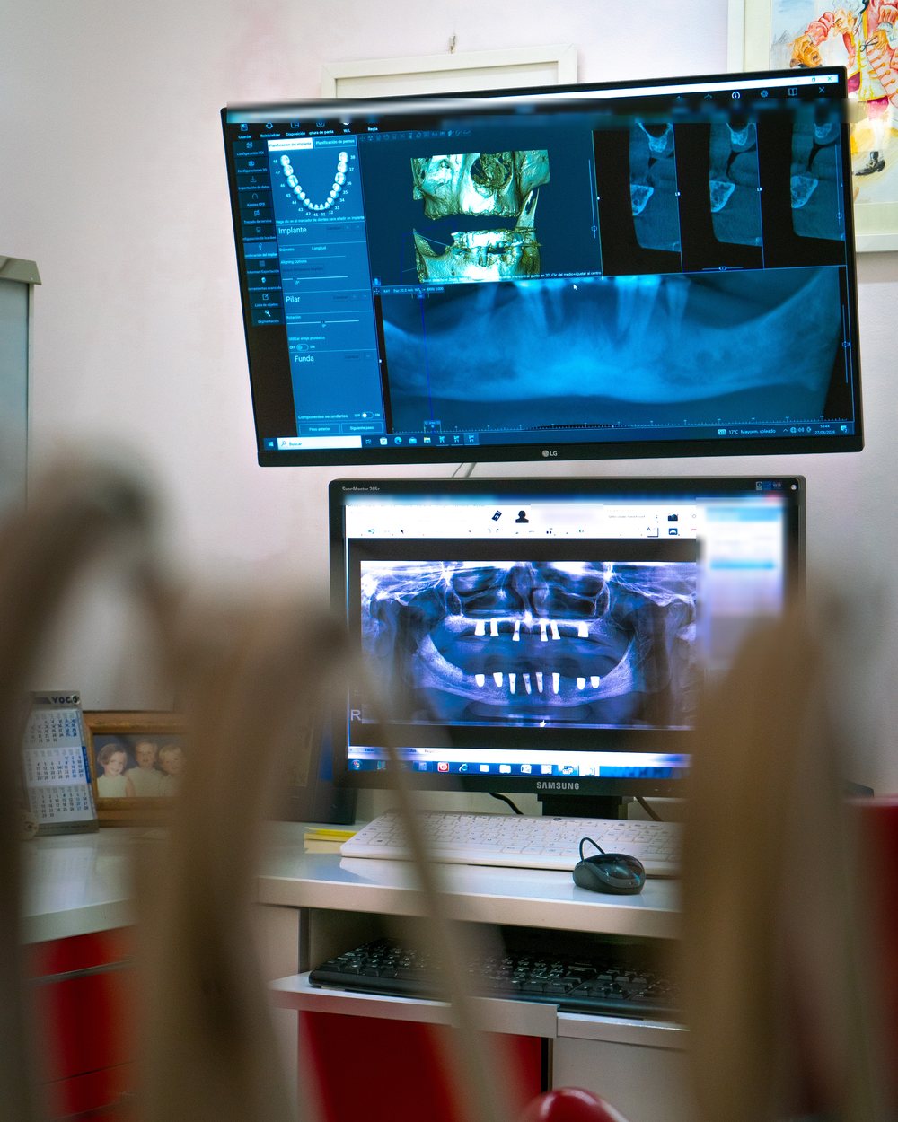 Planificación digital de implantes dentales sobre TAC 3D en la Clínica Dental De Vega Marín